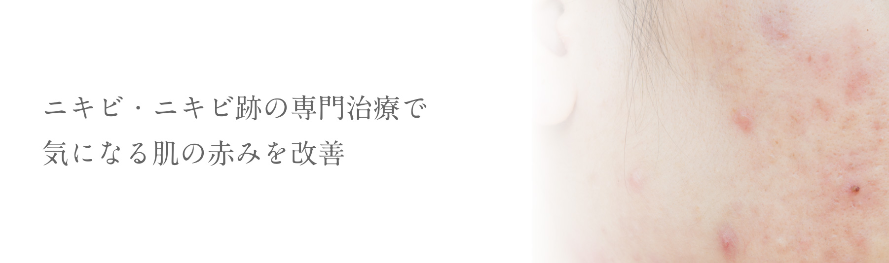 ニキビ・ニキビ跡の専門治療で気になる肌の赤みを改善
