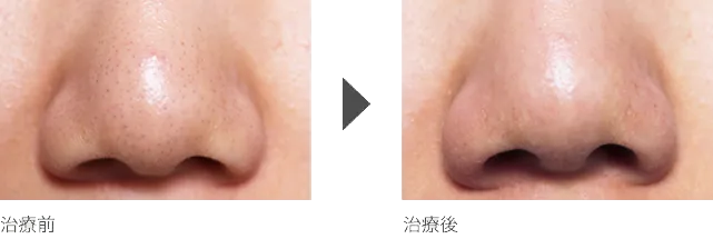 毛穴の黒ずみ除去 40代女性