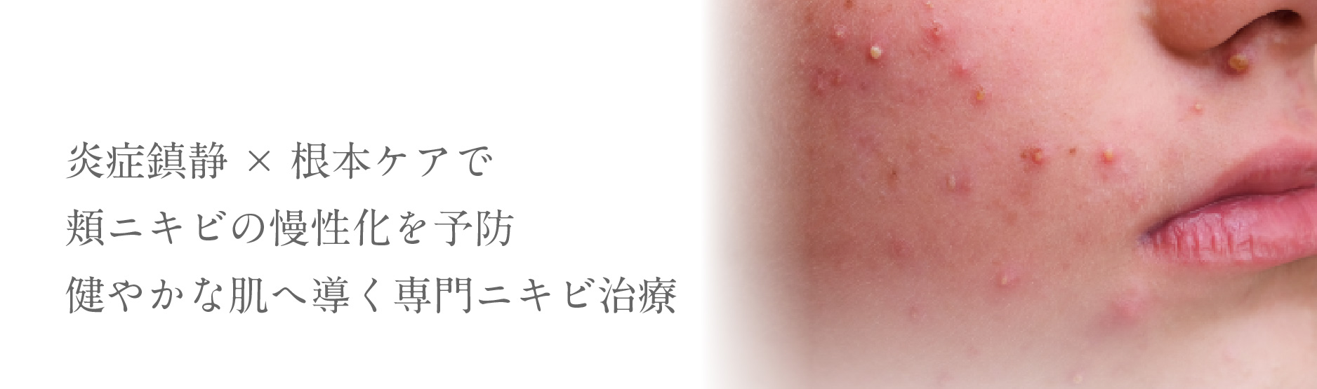 炎症鎮静×根本ケアで頬ニキビの慢性化を予防健やかな肌へ導く専門ニキビ治療