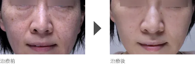 頬のシミ治療 40代女性
