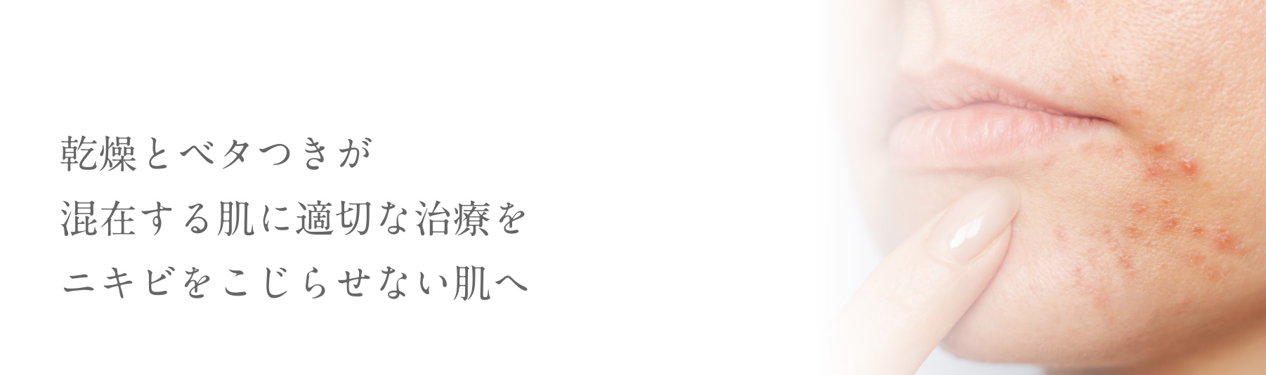 乾燥とベタつきが混在する肌に適切な治療をニキビをこじらせない肌へ