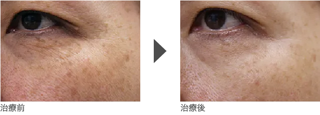 目の下、目元のしわ治療 50代女性