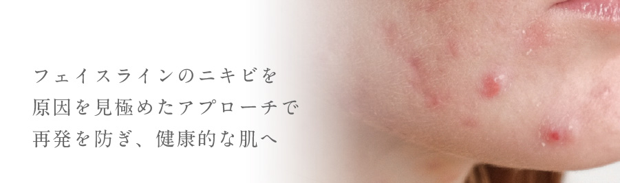 フェイスラインのニキビを原因を見極めたアプローチで再発を防ぎ、健康的な肌へ