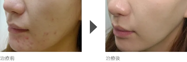 フェイスラインのニキビ治療 20代女性