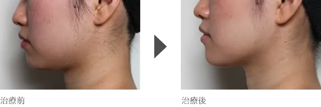 フェイスラインのたるみ 30代女性