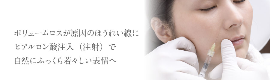 ボリュームロスが原因のほうれい線にヒアルロン酸注入（注射）で自然にふっくら若々しい表情へ
