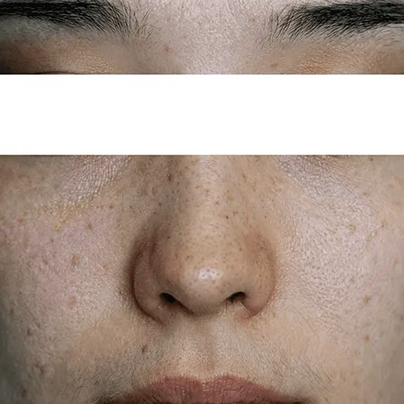 そばかすとは？