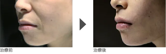 顔のしわ治療 30代女性