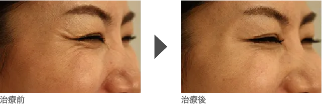 顔のしわ治療 30代女性
