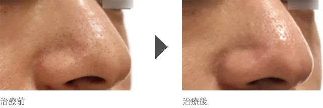 鼻の毛穴治療 20代男性