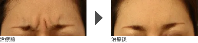 眉間のしわ治療 30代女性