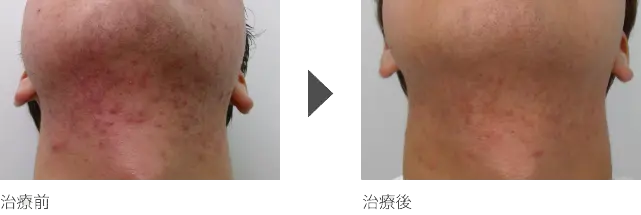 首のニキビ治療 10代男性