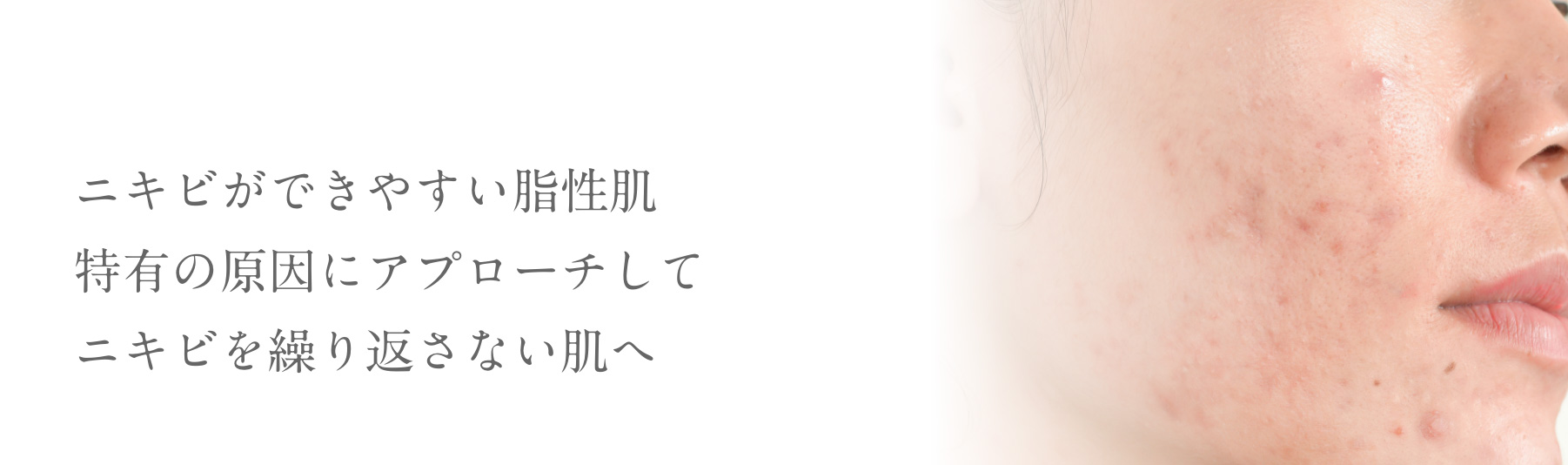 ニキビができやすい脂性肌特有の原因にアプローチしてニキビを繰り返さない肌へ