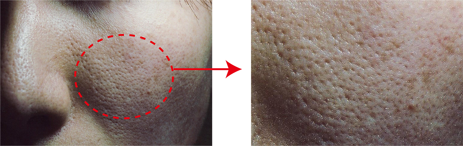 毛穴の開き（開き毛穴）