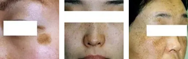 産後にできるシミとは?