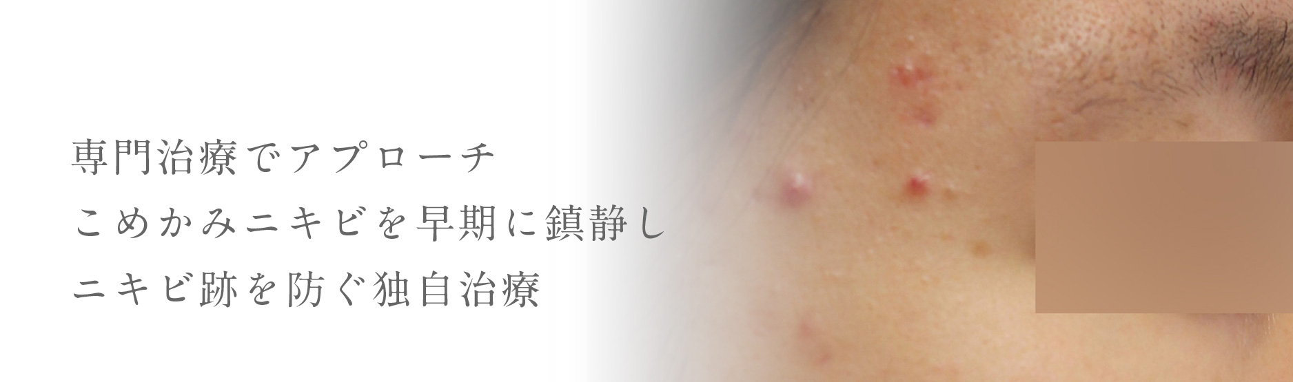 専門治療でアプローチこめかみニキビを早期に鎮静しニキビ跡を防ぐ独自治療