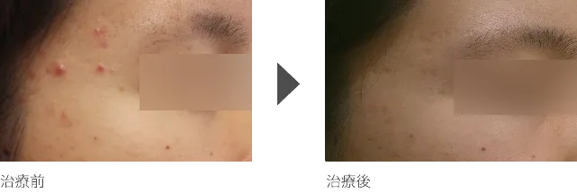 こめかみのニキビ治療 20代女性