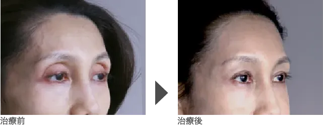 ほうれい線のヒアルロン酸注入（注射）の症例 50代女性
