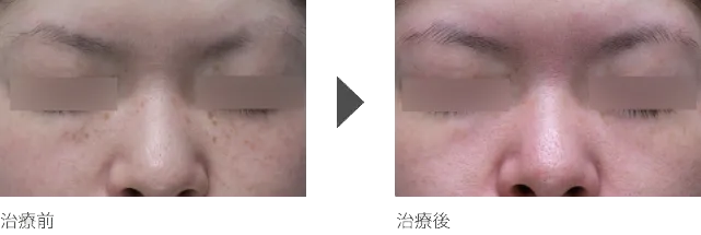 目の下、目元のシミ治療 30代女性