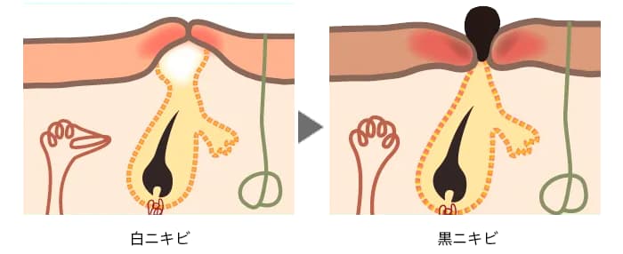 黒ニキビとは？