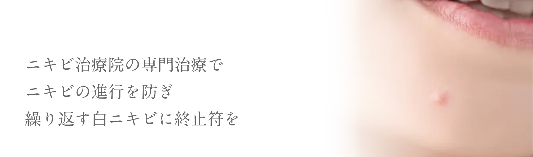 ニキビ治療院の専門治療でニキビの進行を防ぎ繰り返す白ニキビに終止符を