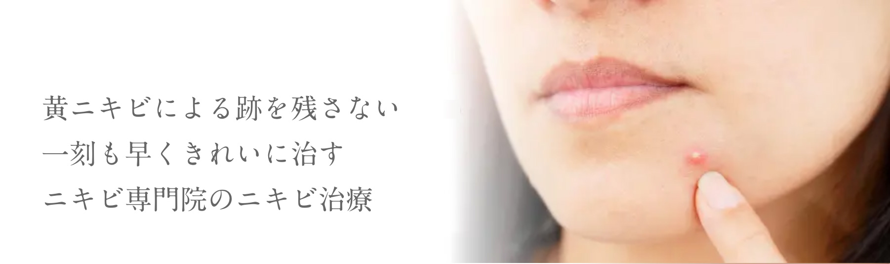 黄ニキビによる跡を残さない一刻も早くきれいに治すニキビ専門院のニキビ治療