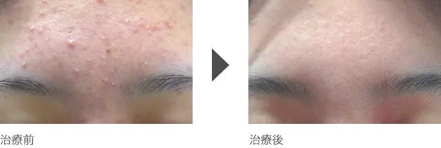 額の黄ニキビ治療 10代女性