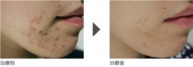 ニキビ、ニキビ跡の赤み治療 20代前半 女性