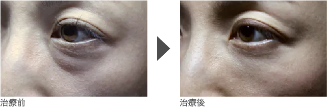 目周り 30代 女性