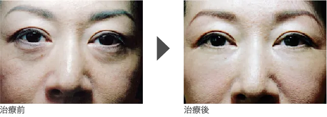 目周り 50代 女性