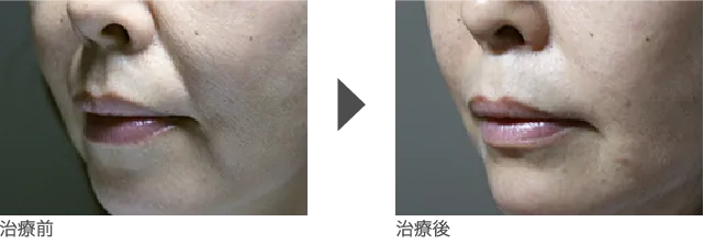 ほうれい線 40代 女性