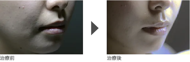 ほうれい線 20代 女性