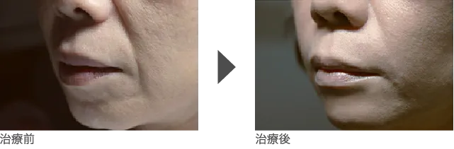 ほうれい線 50代 女性