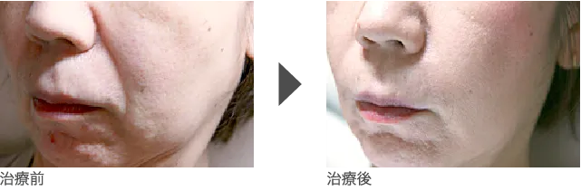 ほうれい線 50代 女性