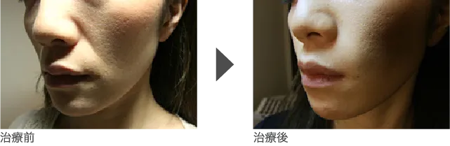 ほうれい線 30代 女性