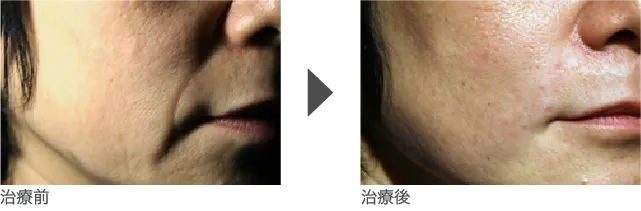 ほうれい線 50代 女性