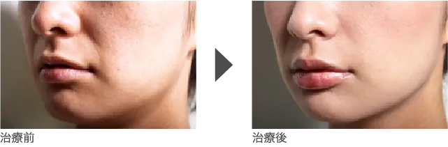 ほうれい線 30代 女性