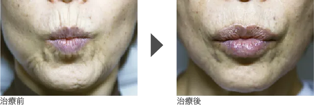 口元 60代 女性