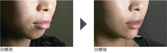 あご 20代 女性