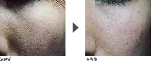 女性 深く、大きく開いた毛穴にお悩みの患者様